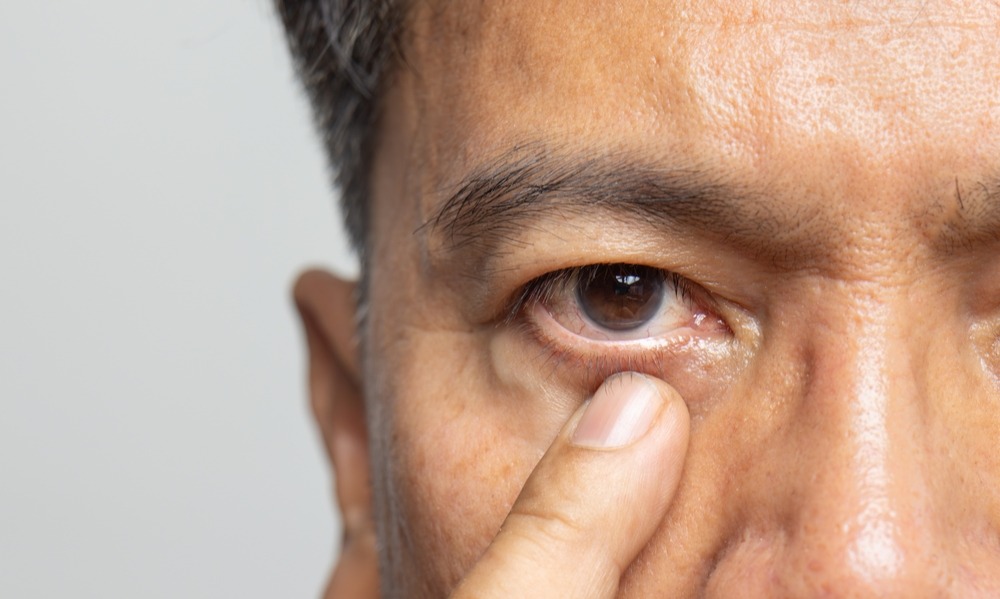 Recovery Tips for Cataract Surgery in Lancaster, PA